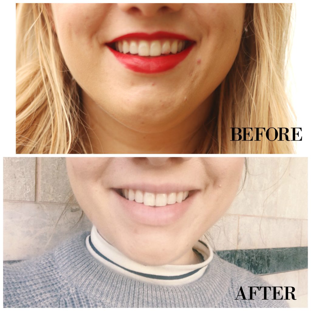 at home teeth whitening before and after